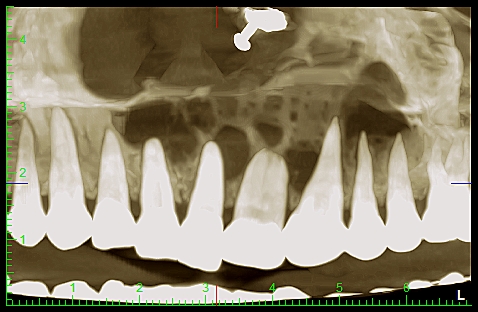 Panoramic radiograph