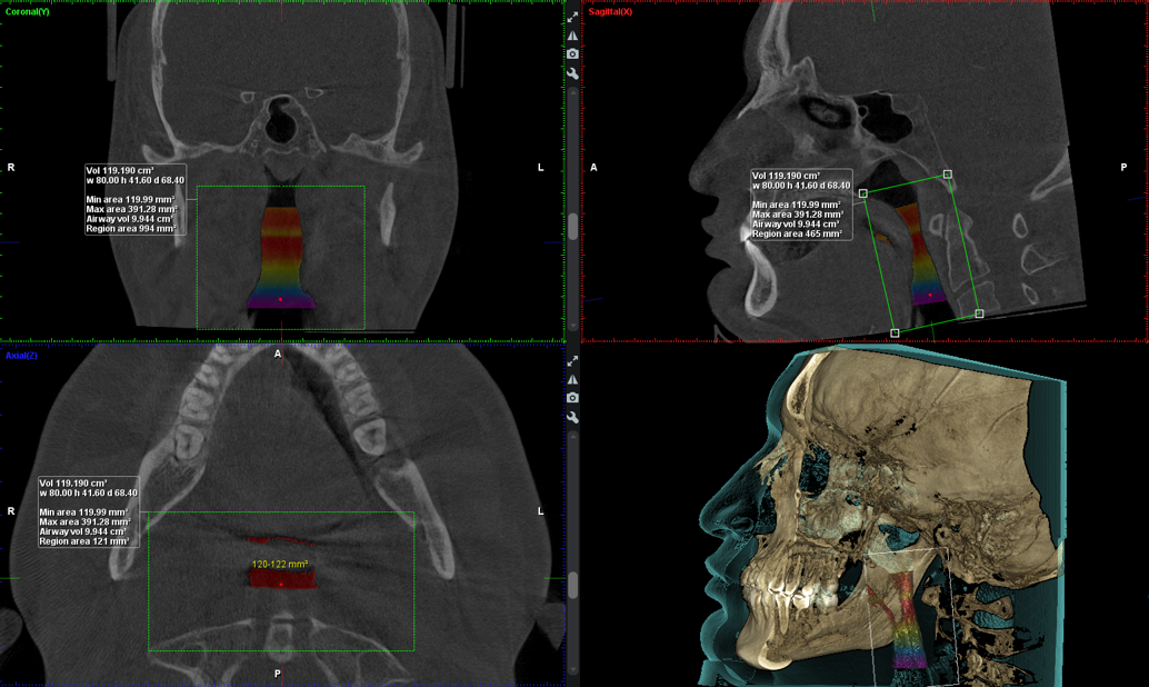 Airway volume analysis