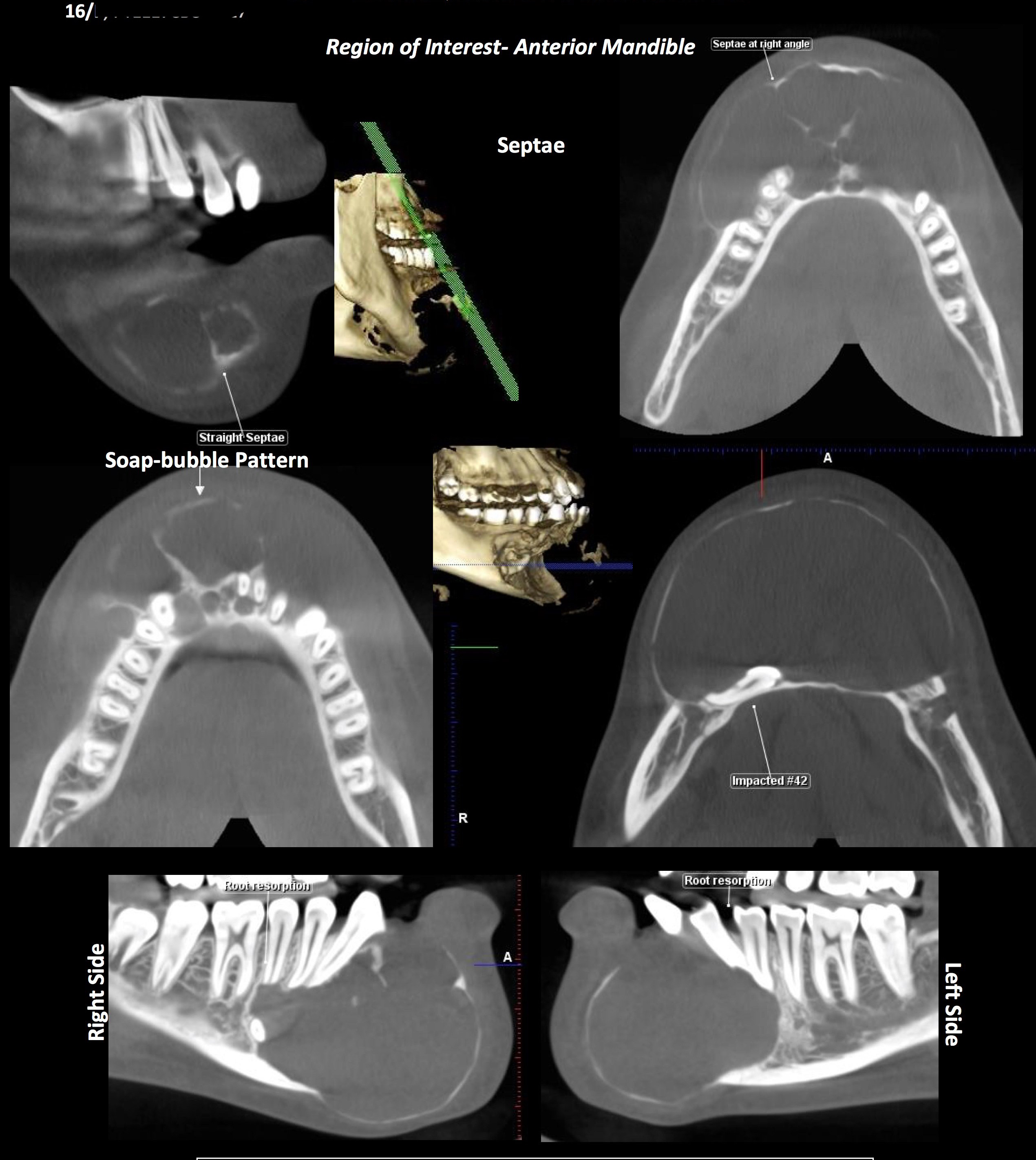 Anterior mandible CBCT