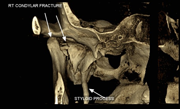 Condylar fracture 3D