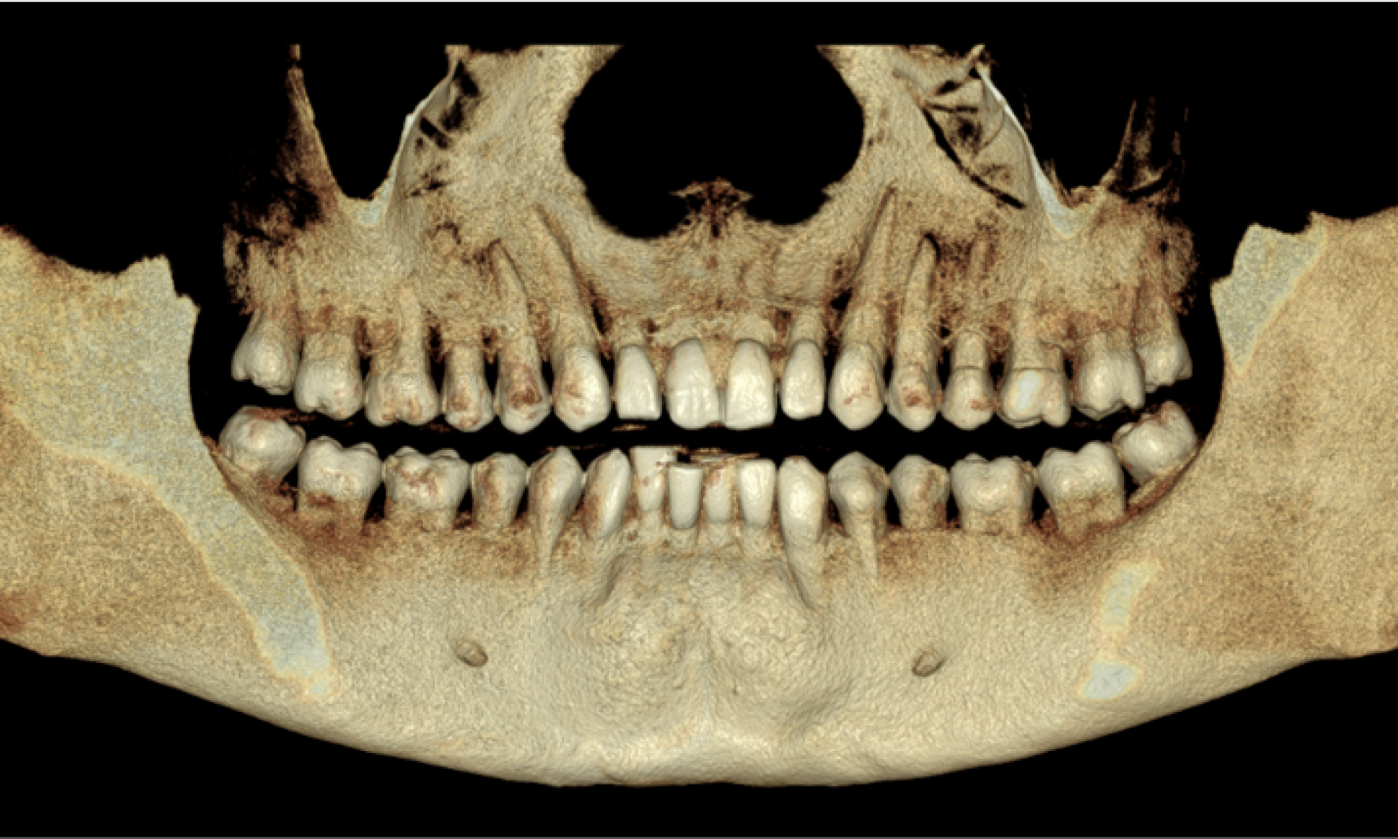 CBCT 3D volume reconstruction