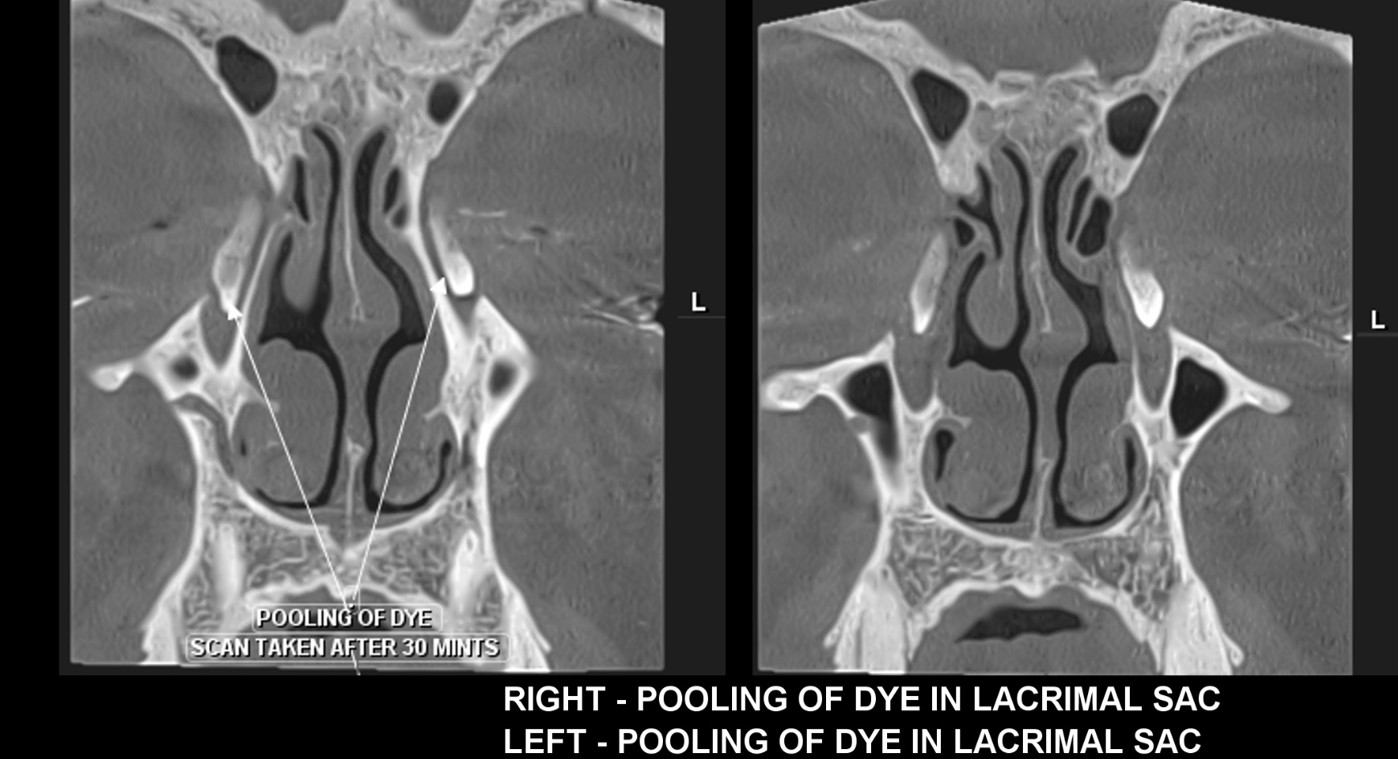 Dacryocystography