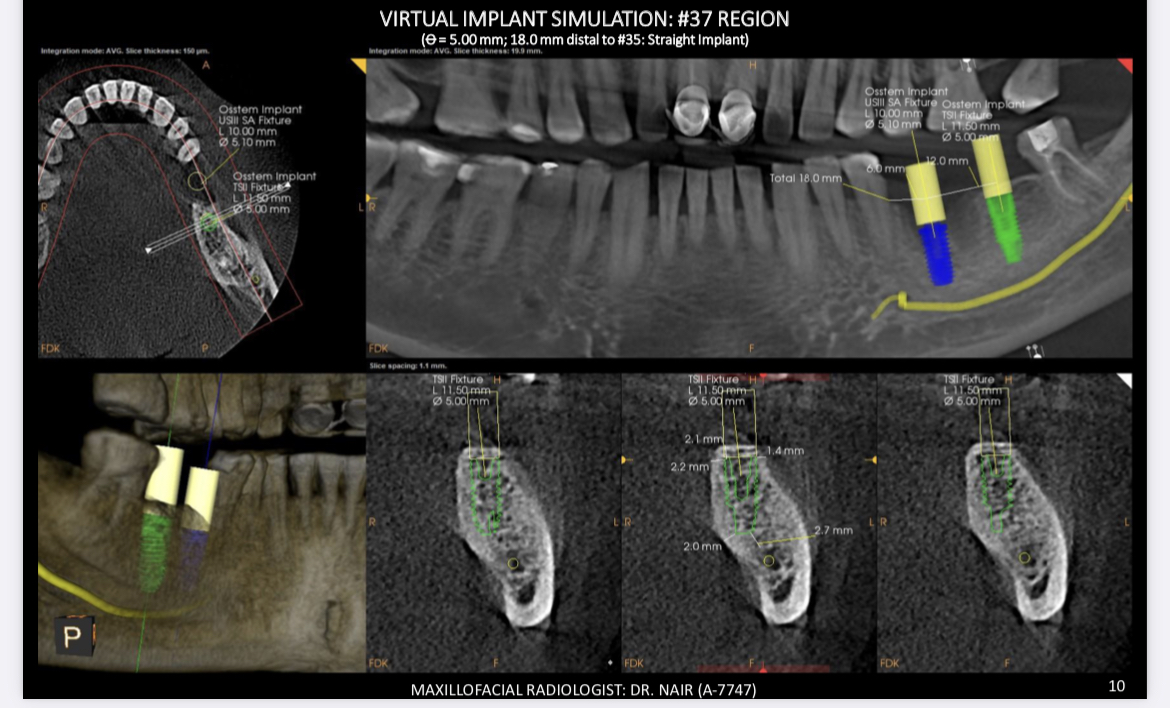 CBCT virtual implant simulation