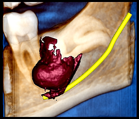 3D jaw radiolucency