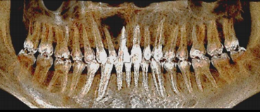 Anterior mandible CBCT