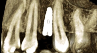Post-implant assessment