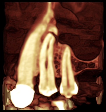 Root fracture 3D