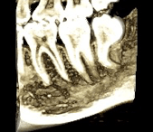 DILACERATED ROOT.png